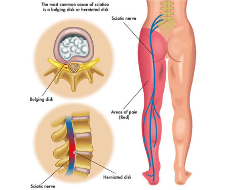 Sciatica Leg Pain Treatment At Home: Tips for Immediate Relief